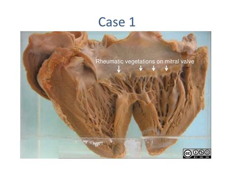 Ppt Rheumatic Heart Disease Powerpoint Presentation Free Download Id 5663159