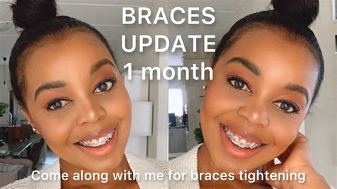 Braces Vlog 1 Month Braces Update Come Along With Me For Braces