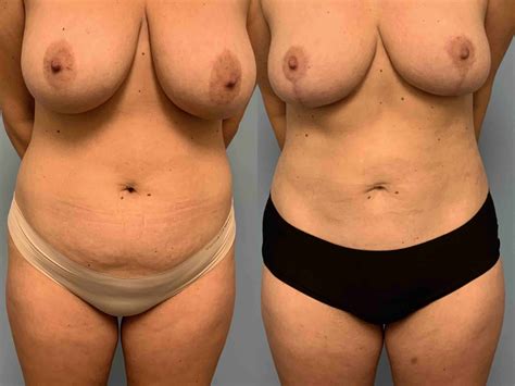 Breast Reduction Gallery Dr Paul Vanek