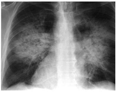 dokter post tatalaksana edema paru  pasien  dengue shock