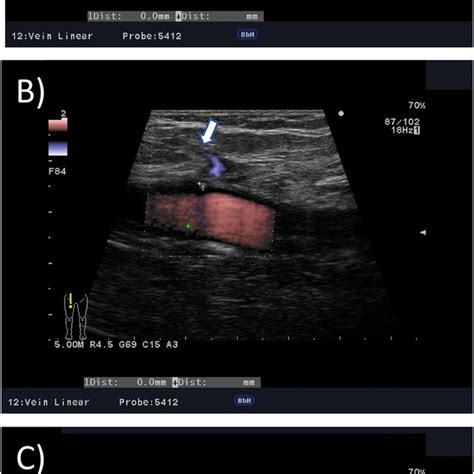 One Process Leading To Anterior Accessory Saphenous Vein Recanalization