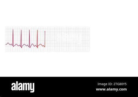 Animated Electrocardiograph Monitor Graph That Shows Sinus Tachycardia