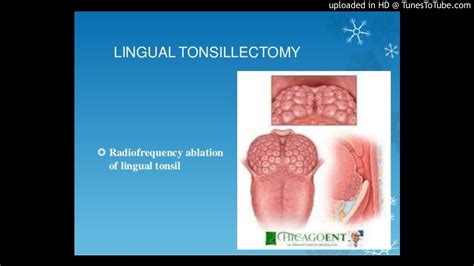 Lingual Tonsillectomy With Palatal Surgery For The Treatment Of Obstructive Sleep Apnea Youtube