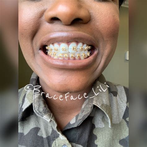 Gold Braces Colored Bands