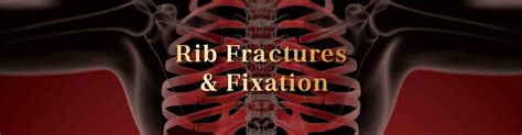 Rib Fracture And Fixation From Trauma International Centre For Thoracic