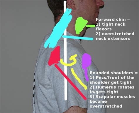 Neck strain | Massage therapy, Neck strain, Trigger point therapy