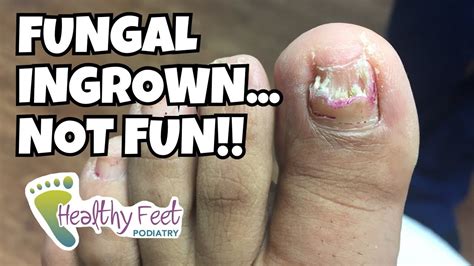 Removing A Fungal Ingrown Nail Youtube