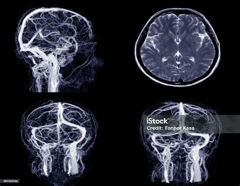 Magnetic Resonance Venography Otak Pembuluh Darah Di Kepala Manusia