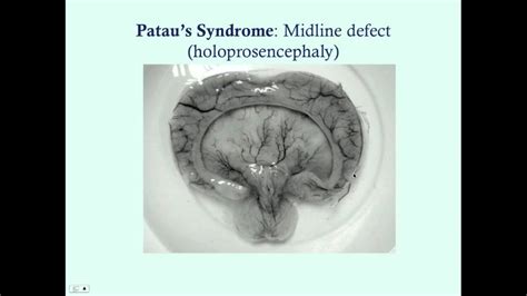 Pataus And Edwards Syndrome Crash Medical Review Series Youtube