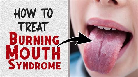 How To Get Relief From Burning Mouth Syndromes Fast Home Remedies For Burning Mouth Youtube