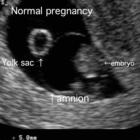 Blighted Ovum Cause Symptoms Ultrasound Treatment Prevention Etc