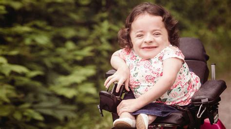 Osteogenesis Imperfecta Poses Vision Risks | Ophthalmology | Michigan ...