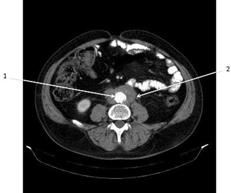 Retroperitoneal Fibrosis