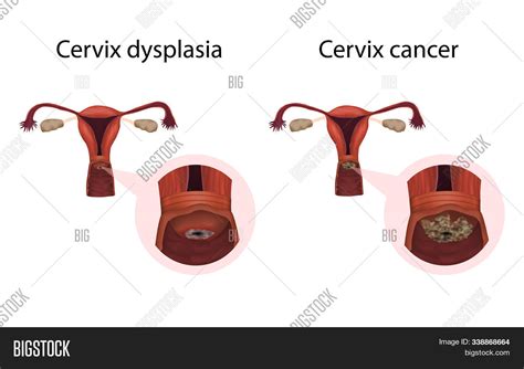 Cervix Dysplasia Image And Photo Free Trial Bigstock