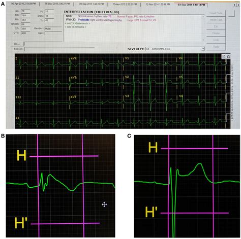 Screenshot Of The ECG Analysis Program A A Type 1 Brugada Pattern