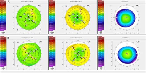 Corneal Topography Pentacam Corneal Topography Demonstrates Minimal