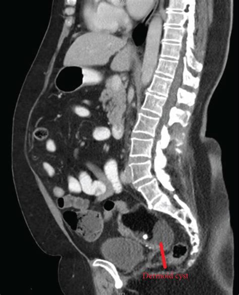 Sagittal View Of Ct Abdo Pelvis Showing A Likely Dermoid Cyst In The