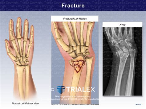fracture trialquest
