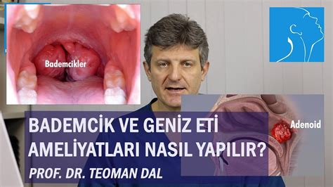 BADEMCİK VE GENİZ ETİ AMELİYATLARI NASIL YAPILIR PROF DR TEOMAN DAL