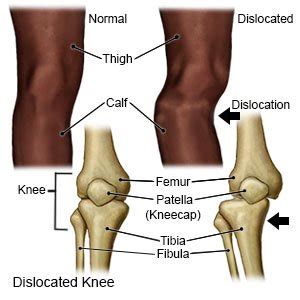 Knee Dislocation - What You Need to Know