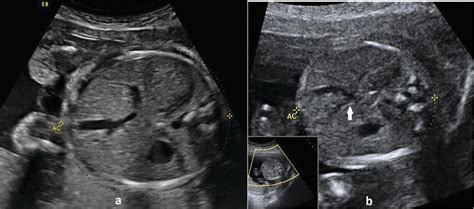 Abnormalities Of Umbilical Cord