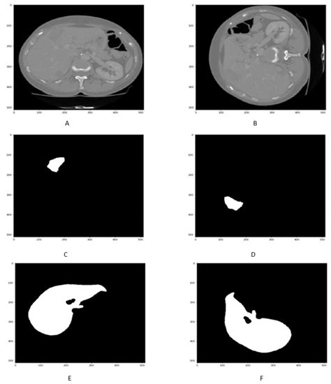 Applied Sciences Free Full Text Segmentation Of Liver Tumor In Ct Scan Using Resu Net