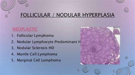 Patterns Of Lymph Node Hyperplasia