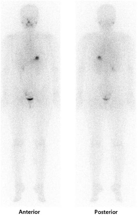 123 I Diagnostic Whole Body Scan Shows No Abnormal Iodine Uptake