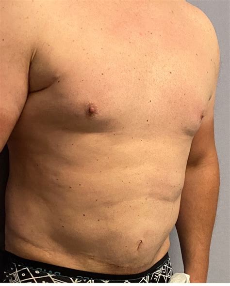 Male Tummy Tuck Ab Implants Oblique 1 Dr Barry Eppley Explore Plastic