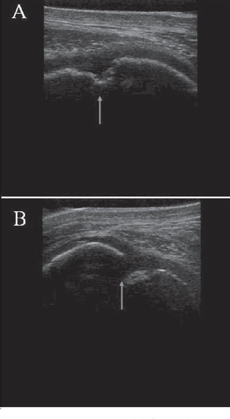 Figure From How To Perform Ultrasound Guided Injection Of