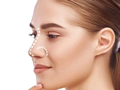 Promoci N Rinoseptoplastia Cirug A Facial En Santiago