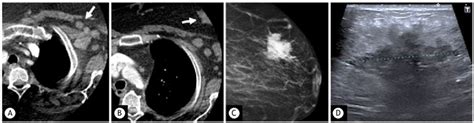 Axial CT images show an incidental finding of multiple left axillary... | Download Scientific ...