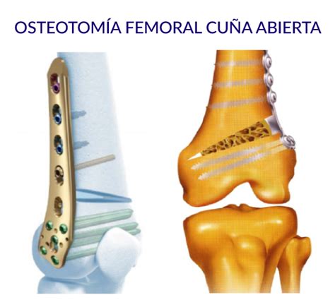 Cómo se realiza la osteotomía femoral FisioOnline