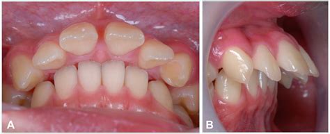 Class Ii Malocclusion With Severe Overjet Treated With Maxillary Second