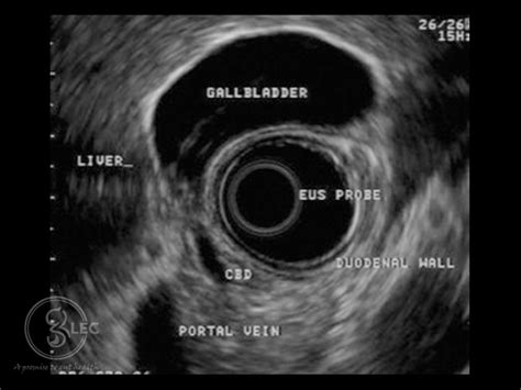 Endoscopic Ultrasonography Gastroliver