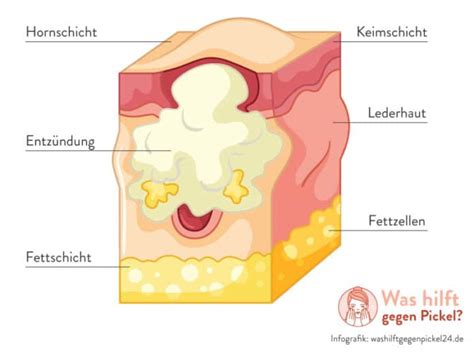 Pickel Unter Der Haut Unterirdische Pickel Ratgeber