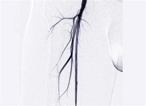 Angiogram งเป นตอนทางการแพทย ในการมองเห นหลอดเล อดในบร เวณขาหน