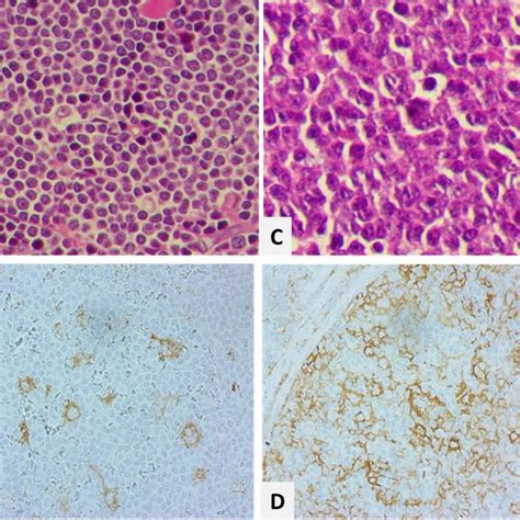 Hematoxylin Eosin With PDL1 Immunohistochemical Staining Images Of