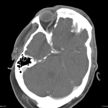 Basilar Thrombosis With Hemorrhagic Transformation Image