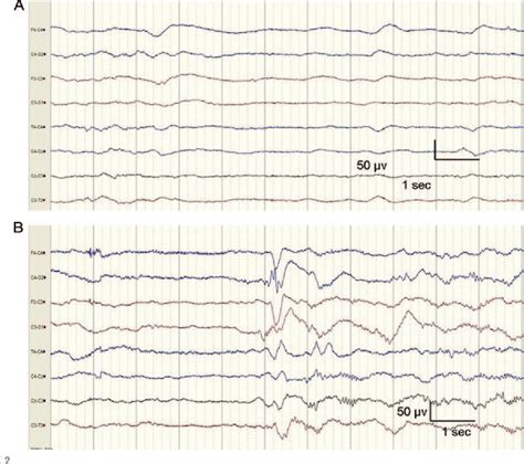 Early Eeg Findings In Hypoxic Ischemic Encephalopathy Predict Outcomes