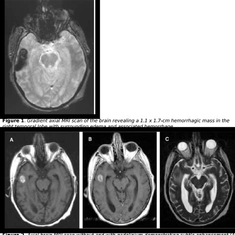 Figure From Disseminated Mycobacterium Avium Intracellulare Infection