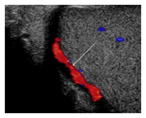 Ultrasonogram Of A Testis Using Color Pulsed Wave Doppler Download