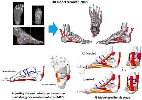Biomechanical Effects of Medializing Calcaneal Osteotomy on Bones and
