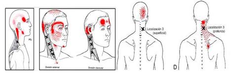 Fisioterapia Para La Cervicalgia O Dolor Cervical Avanfi