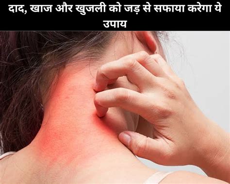 8 Holistic Remedies For Ringworm Scabies And Itching In Hindi दाद