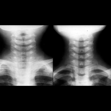 Croup | Pediatric Radiology Reference Article | Pediatric Imaging