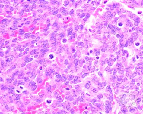 Undifferentiated Metastatic Neuroblastoma - 10.