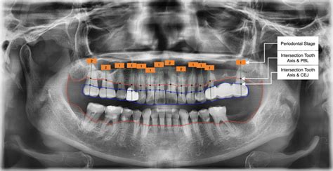 Periodontal Stage Classification According To The Rbl Ratio Using The