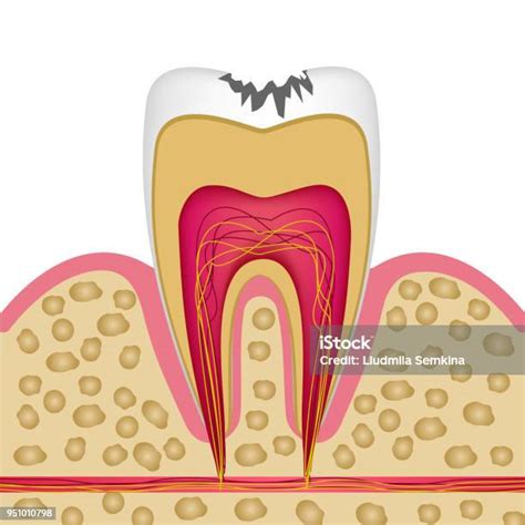 Ilustración De Estructura Del Diente En Sección Transversal Con Caries