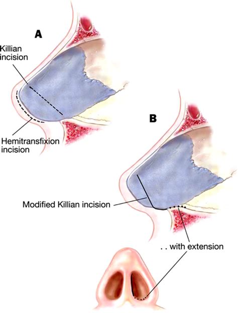 Septoplasty Incisions